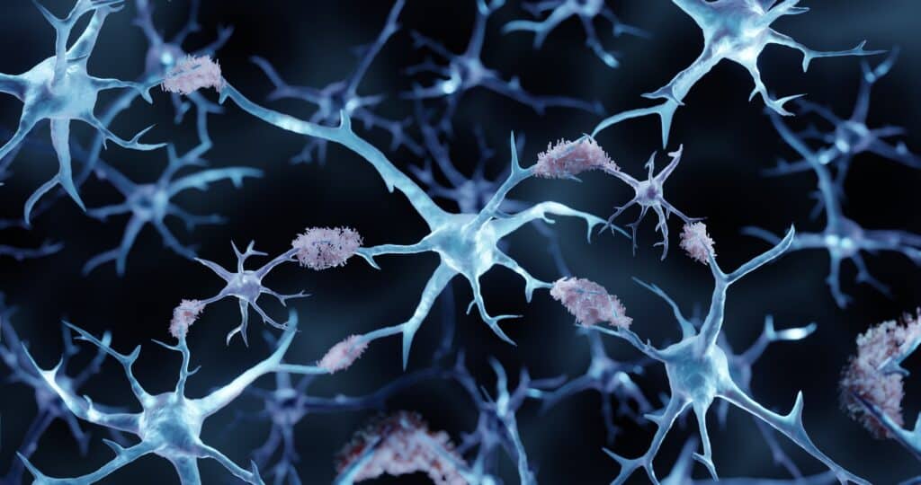 Beta-amyloid plaques