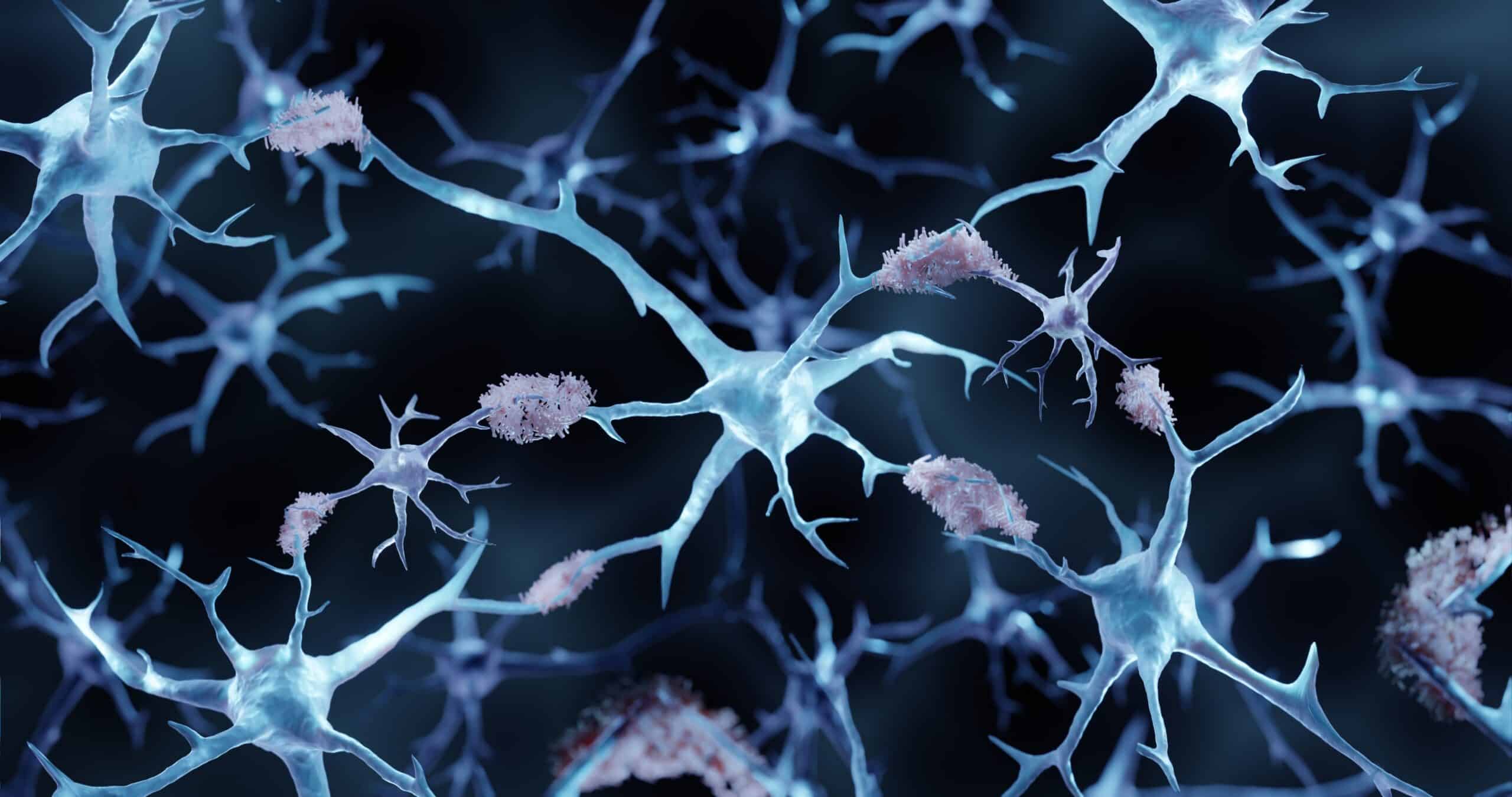 Alzheimer’s disease, Amyloid plaques aggregates