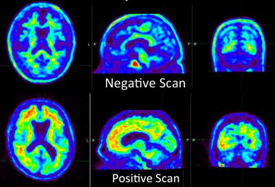 PET scans of brains, half showing amyloid in the brain.