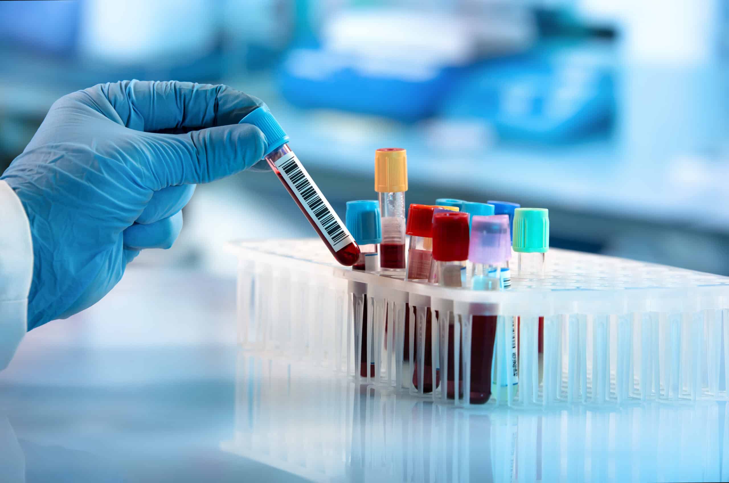 Scientist holding blood test